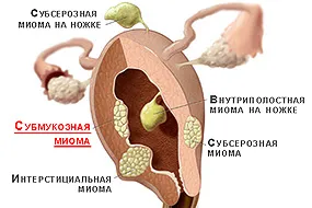 Миома на матката - лечение с ултразвук