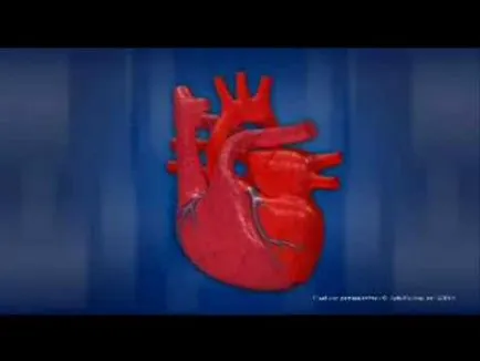 Mitrale (aortică) configurație cardiacă