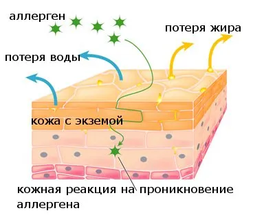 Weeping екзема симптоми, лечение плач лишава човек, кучета и котки