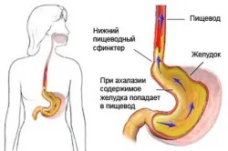 Eșecul akalazia esofagian