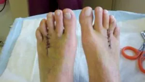 Neuroma a piciorului (Morton Neuroma) simptome si tratament