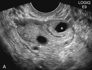 Normál petefészkek ultrahanggal (előadás diagnostere)