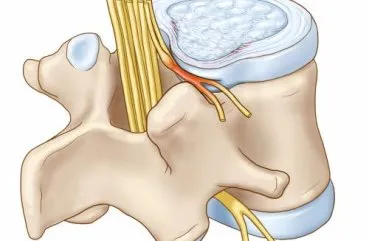 Neuroma a coloanei vertebrale și a măduvei spinării tratamentul simptomelor cervicale și toracice și cauzele bolii