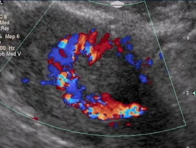 Normál petefészkek ultrahanggal (előadás diagnostere)