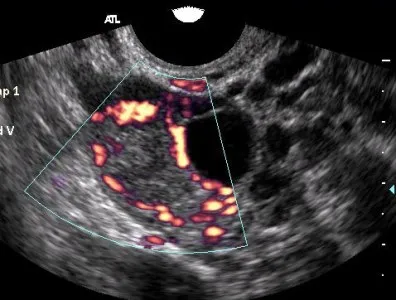 Normál petefészkek ultrahanggal (előadás diagnostere)