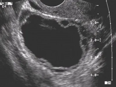 ovare normale pe ecografie (curs diagnostere)