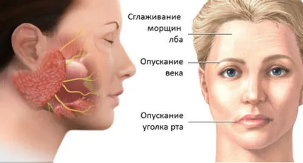 Невралгия на лицевия нерв - етиология, лечение, превантивни мерки