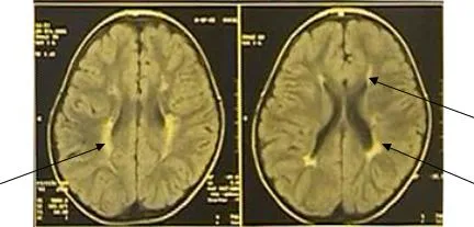 Tratamentul neurochirurgical tulburărilor motorii cu paralizie cerebrală