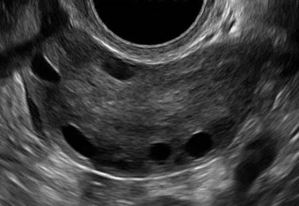 Normál petefészkek ultrahanggal (előadás diagnostere)