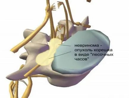 Neuroma a coloanei vertebrale și a măduvei spinării tratamentul simptomelor cervicale și toracice și cauzele bolii