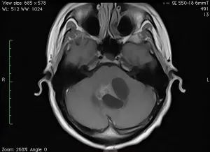 A tumor a kisagy az agy tünetek, okok, diagnózis, kezelés és a prognózis