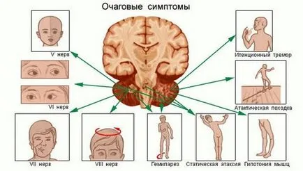 Tumoare simptome cerebrale, cauze si tratament