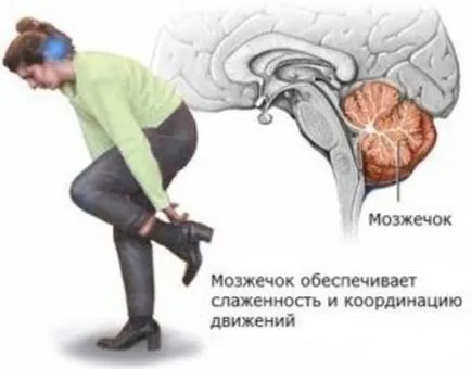 Туморните церебрални симптоми, причини и лечение