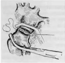 Jellemzői coarctatio aorta