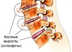 osteofite spinării