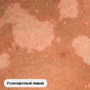 Chromophytosis човек питириазис многоцветни лишеи