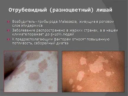 Chromophytosis човек питириазис многоцветни лишеи