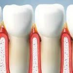 Periodontita in tratamentul diabetului zaharat bolii parodontale si pierderea dintilor