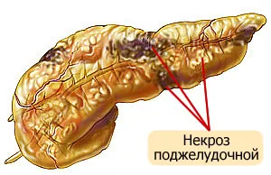 Панкреатична некроза на панкреаса причинява симптомите и лечението