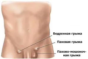 Ингвинална херния в мъже, симптоми, усложнения, лечение, снимки