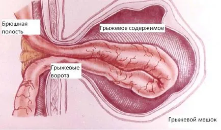 Ингвинална херния в мъже, симптоми, усложнения, лечение, снимки