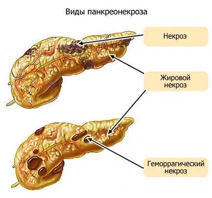 necroza pancreatică a pancreasului cauze, simptome și tratament