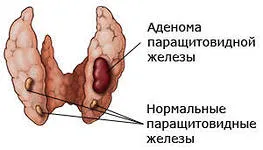 Miért emelt paratiroid hormon