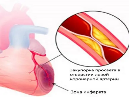 infarct miocardic ICD-10 acută eșec, clasificarea, decriptare