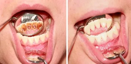 dinți profesionale de preț de curățare, comentarii, înainte și după