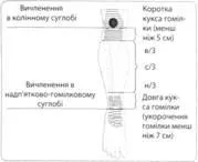 Рехабилитация и протези хората с дефекти на крайниците - травматология и ортопедия