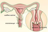 Раждане на матката завой назад последствия