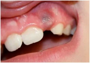 gingii albastre atunci când dentitie copii - de ce nu a existat un hematom