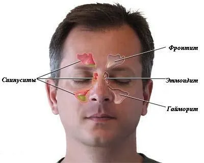 Синузит симптоми и лечение, както е показано и какво да правят,