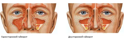 Синузит симптоми и лечение, както е показано и какво да правят,