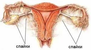 Összenövések a petevezető okoz, a tünetek, diagnózis, kezelés