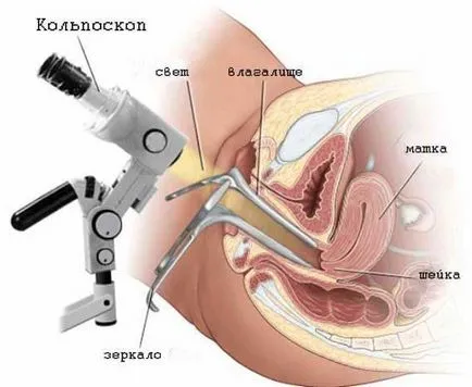 Yodnegativnaya зона по време на колпоскопия