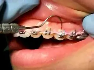 A fogak fogszabályozó tántorog