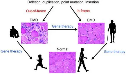 Cure Duchenne izomsorvadás