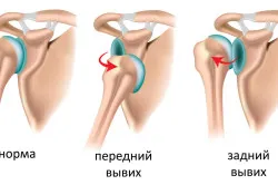 Dislocarea simptomelor mâinilor copilului și ce să facă