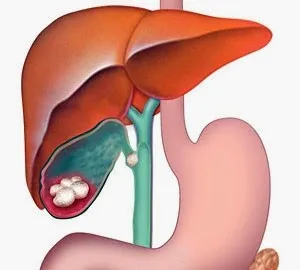 Tratamentul calculi biliari de remedii populare