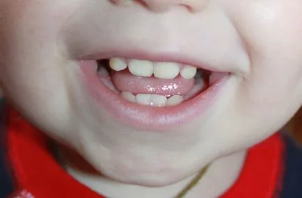 Sárga fogak csecsemők okok és a kezelés