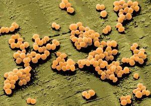 Staphylococcus aureus az orrban a gyermek tünetei és kezelése fertőzések