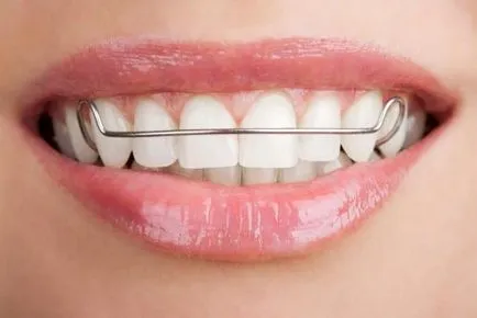 A fogak fogszabályozó tántorog okai, módszerei a harc, a megelőzés