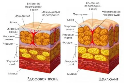 5 exerciții mai eficiente pentru combaterea celulitei