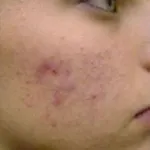 Derma Cote - gél, amely kiküszöböli a hegek