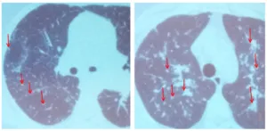 Schimbări și difuze focale de capabilitati CT pulmonare in detectarea si diagnosticul diferențial,