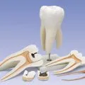 burete hemostatic după extracția dentară, dentare