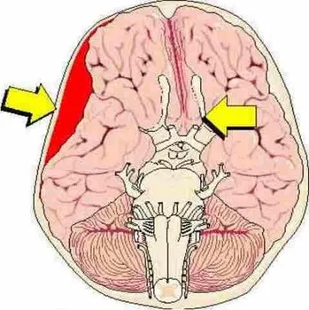 Ganglioma симптоми, причини и диагностика на тумор