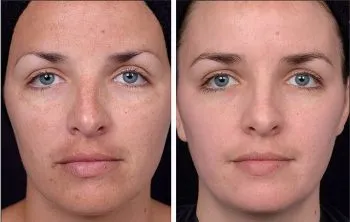 Coji de glycolic pentru comentarii față cu fotografii înainte și după