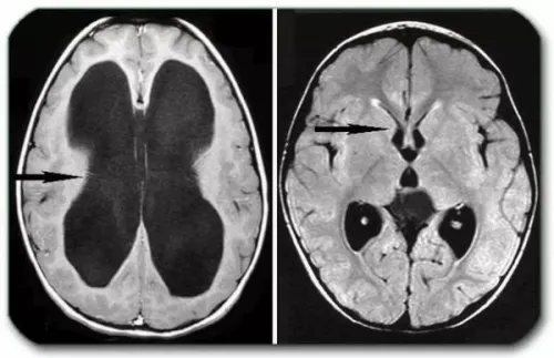 мозъка хидроцефалия при възрастни какво е лечението